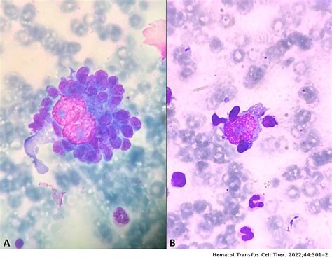 reed-sternberg cells|which is worse hodgkin's or non.